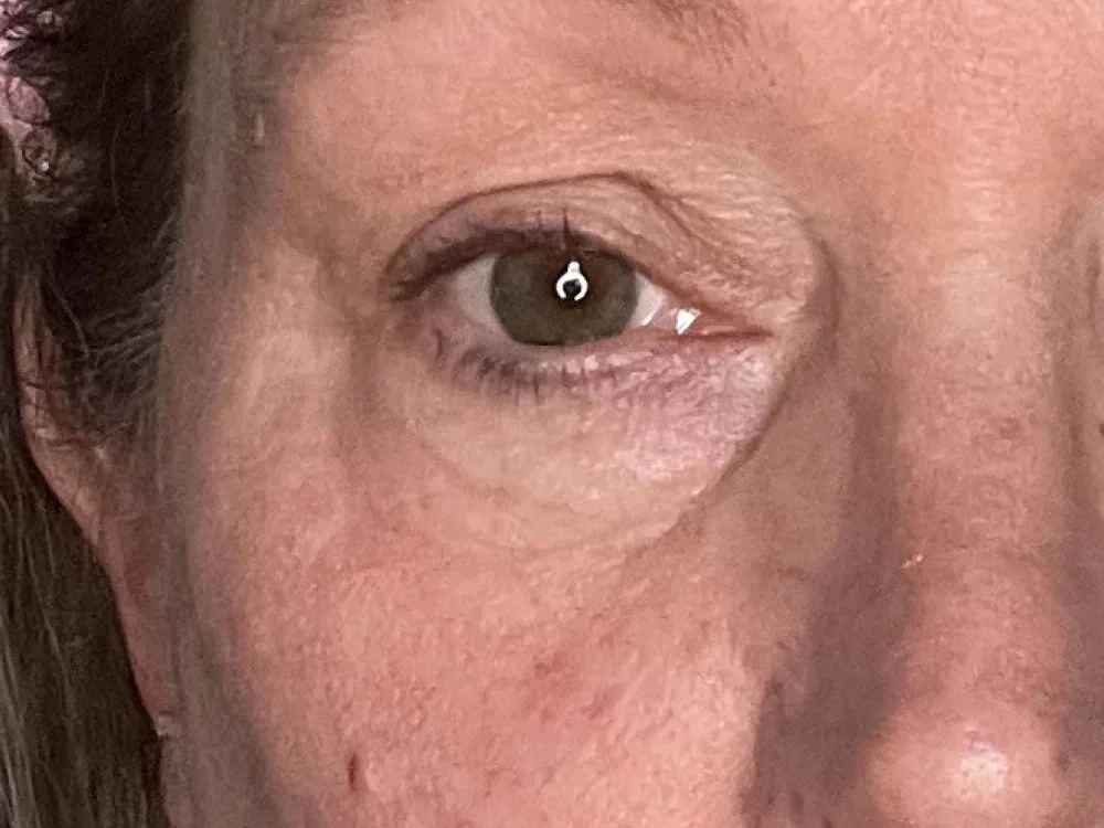 Alecia's eye area on day 1, customer photo supplied by Solawave
