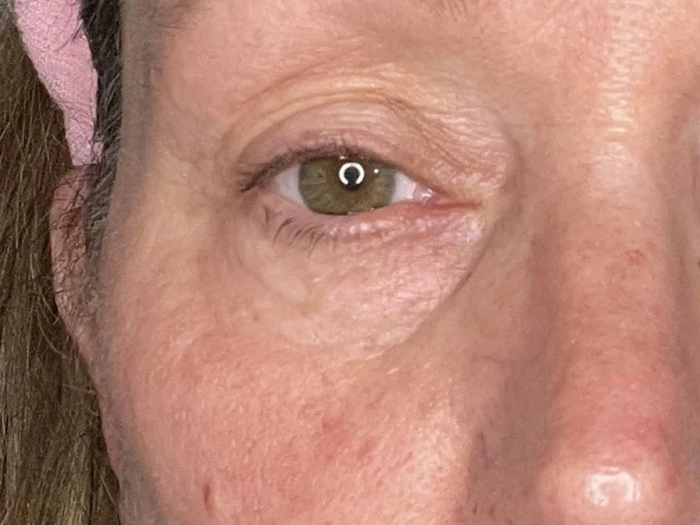Alecia's eye area on day 30, customer photo supplied by Solawave