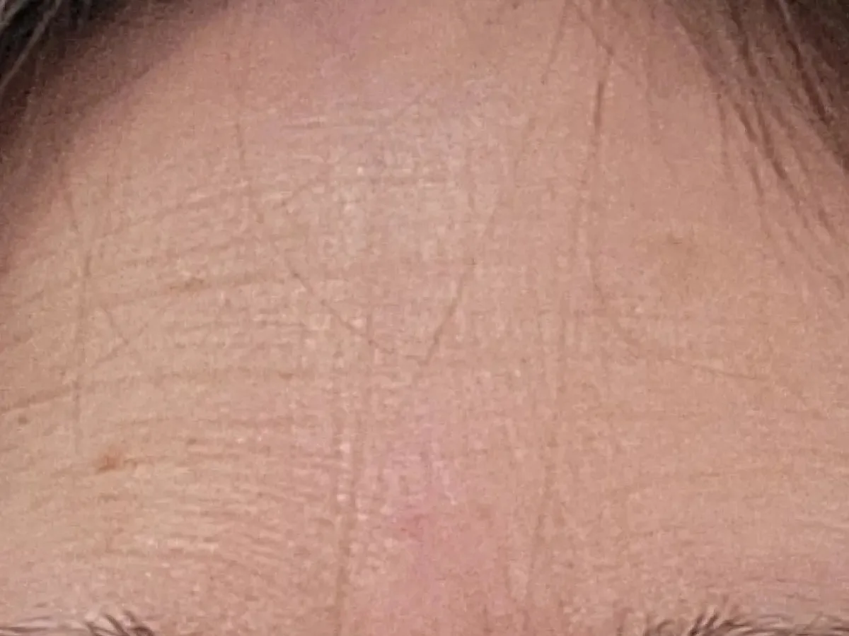 Tammy's forehead on day 1, customer photo supplied by Solawave