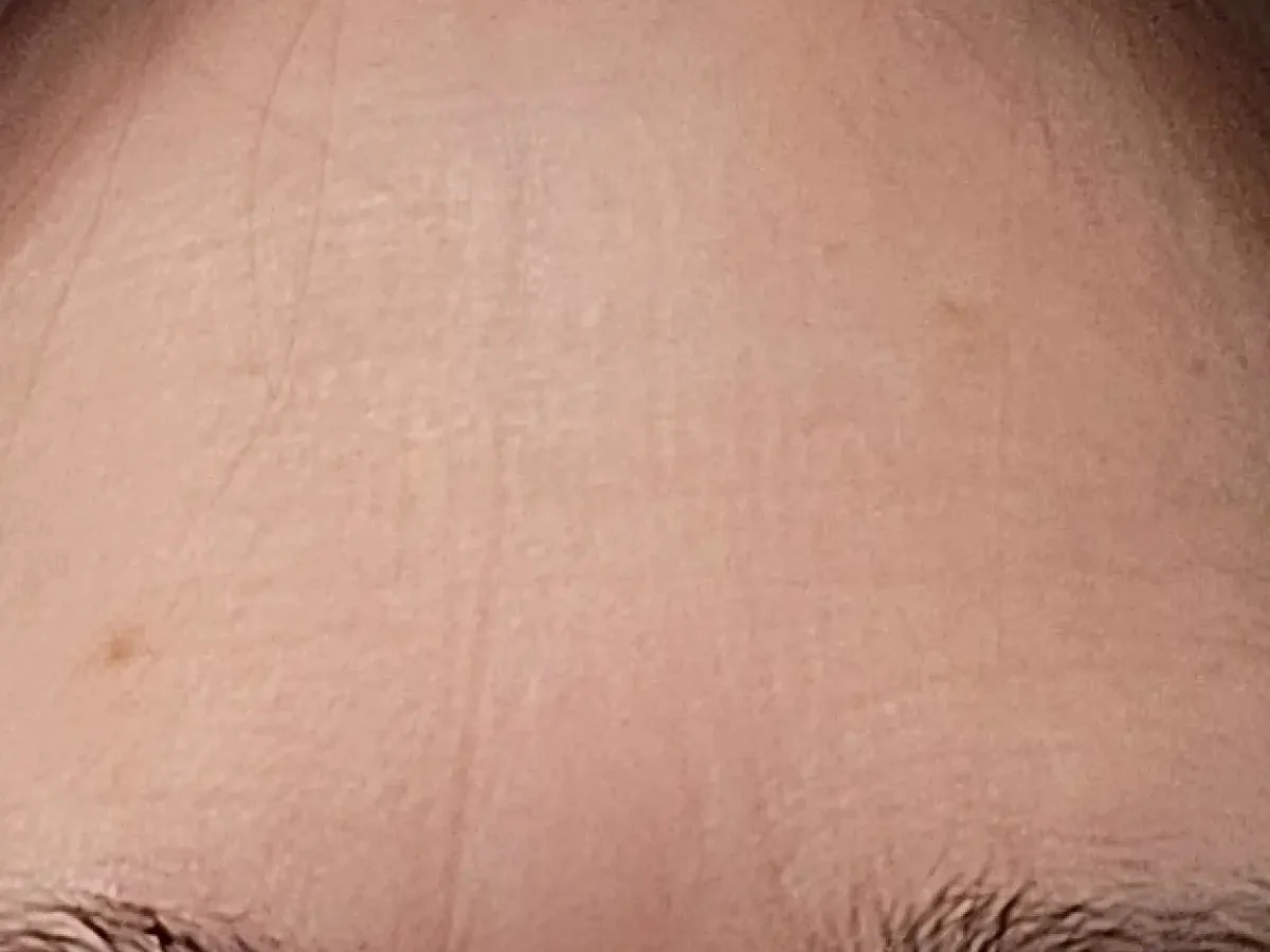 Tammy's forehead on day 30, customer photo supplied by Solawave