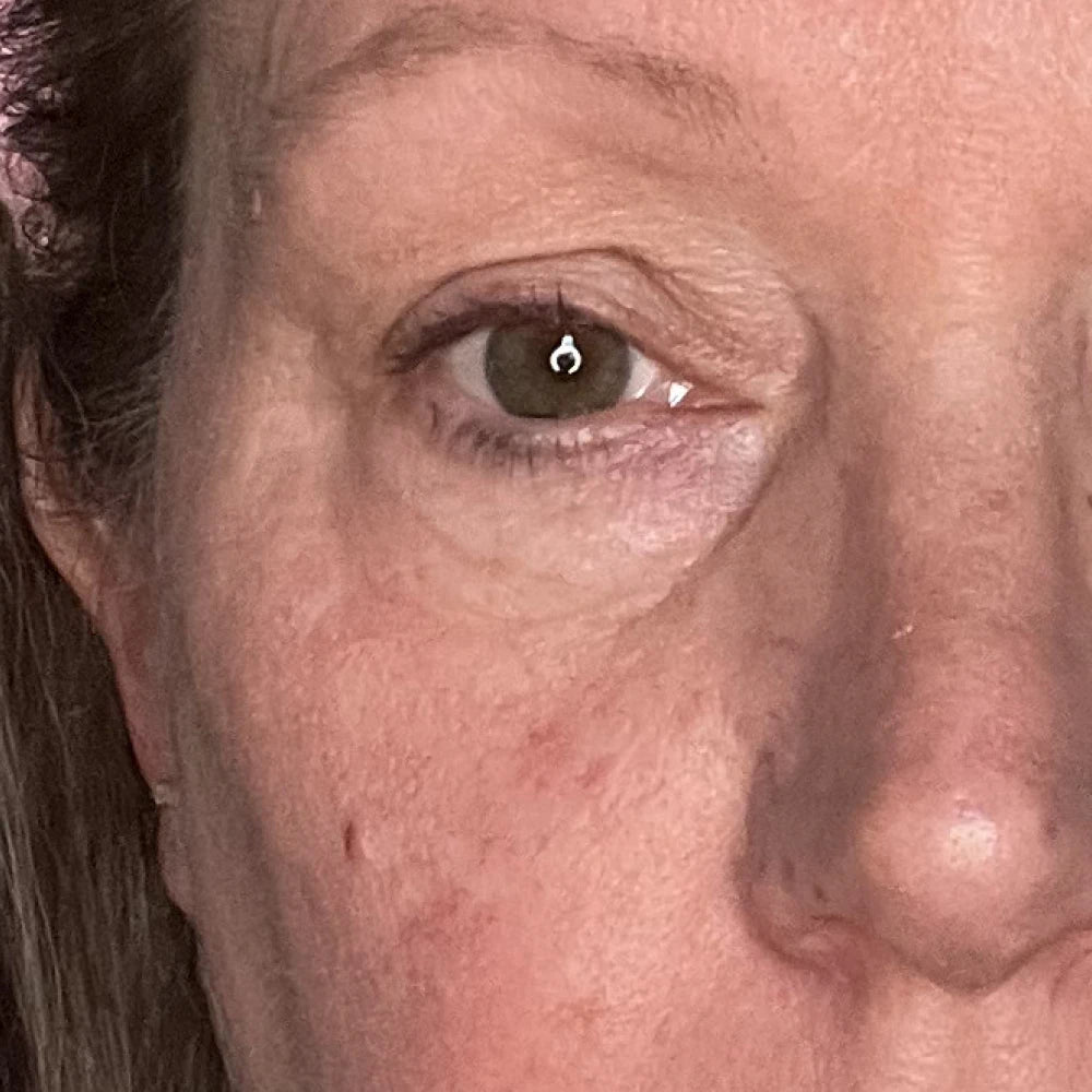 Alecia Day 1 before using Solawave LED mask