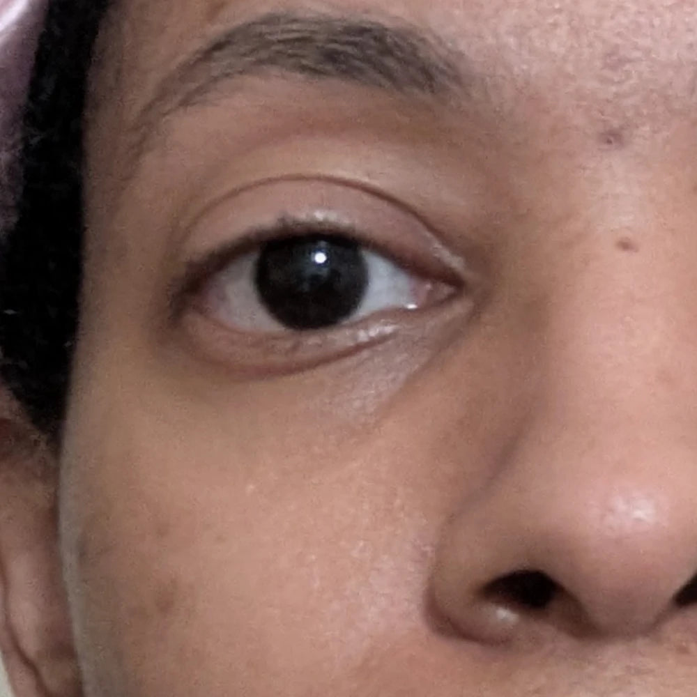 LaTia Day 1 before using Solawave LED mask