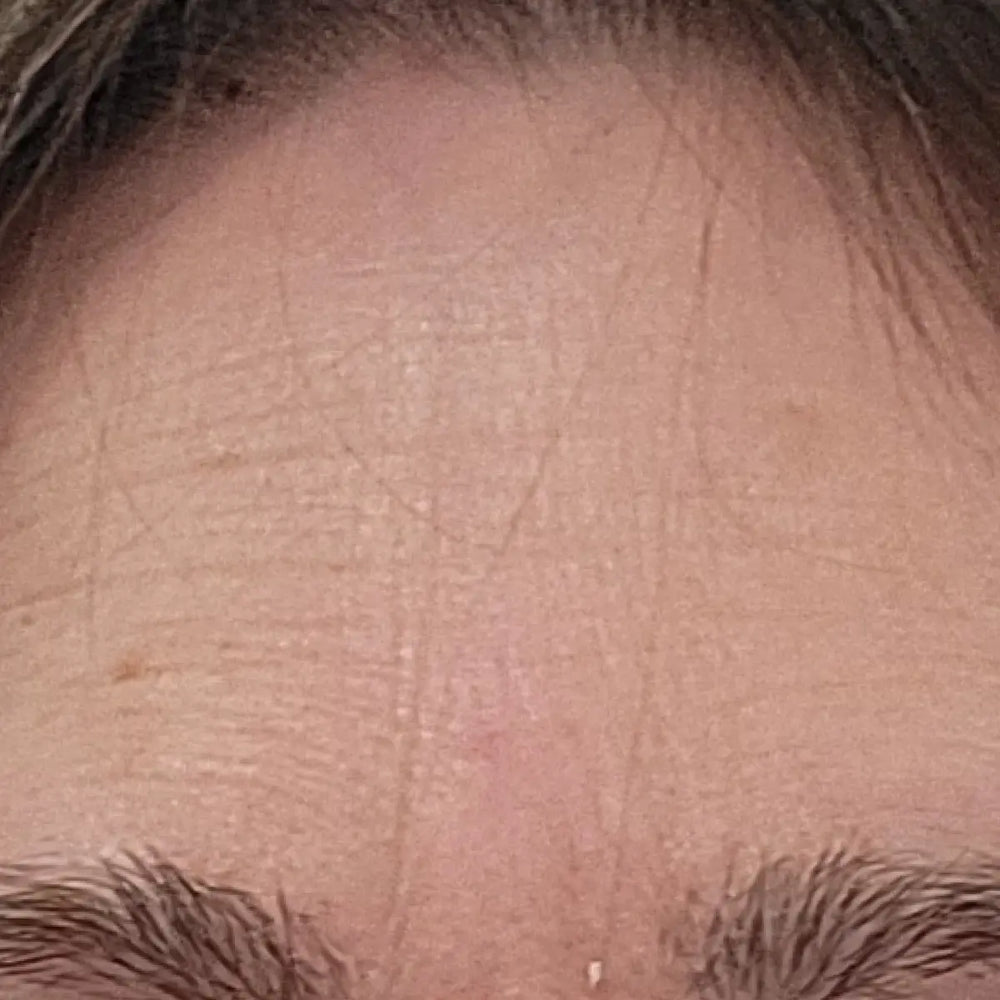 Tammy Day 1 before using Solawave LED mask