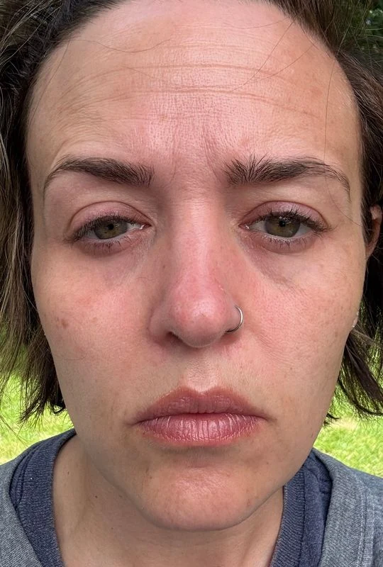 Erin C. fine lines progression after 6 weeks
