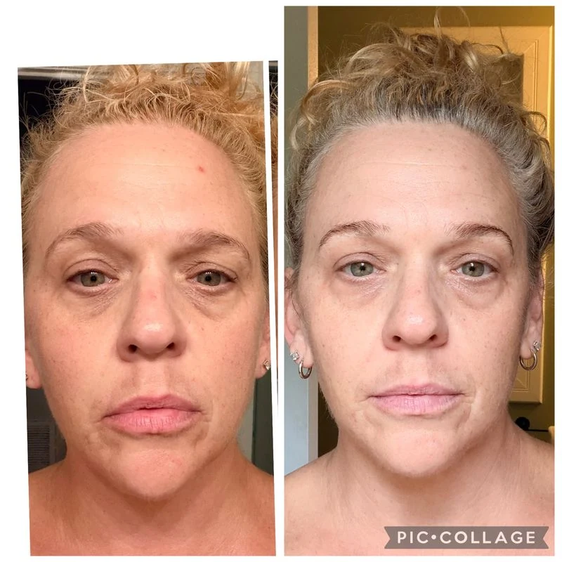 Jennifer W. before and after 6 weeks of using Solawave LED mask